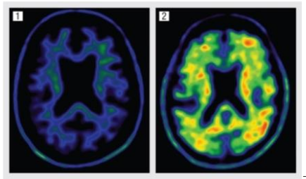 Evidencia dura de que podemos lentificar el avance del Alzheimer a través de ejercitar el cuerpo y la mente (Forbes)